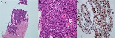 New treatment insights into pancreatic acinar cell carcinoma: case report and literature review